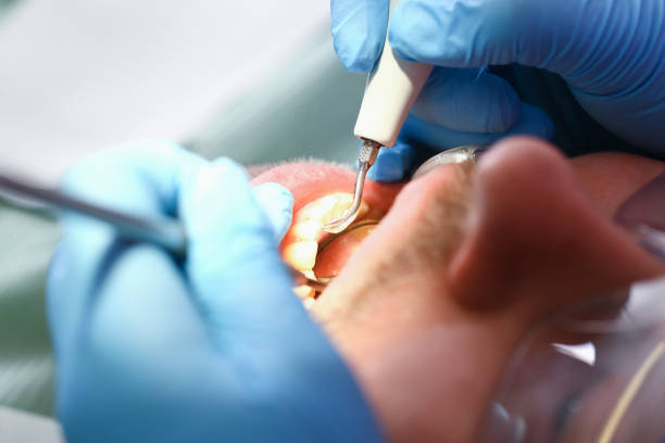 Best Root Canal Emergency Dentist  in Burt, MI